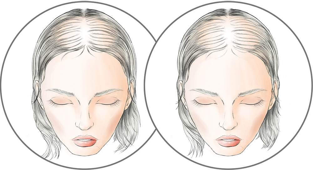 Advanced Stage hairloss diagram for Raquel Welch Transformations