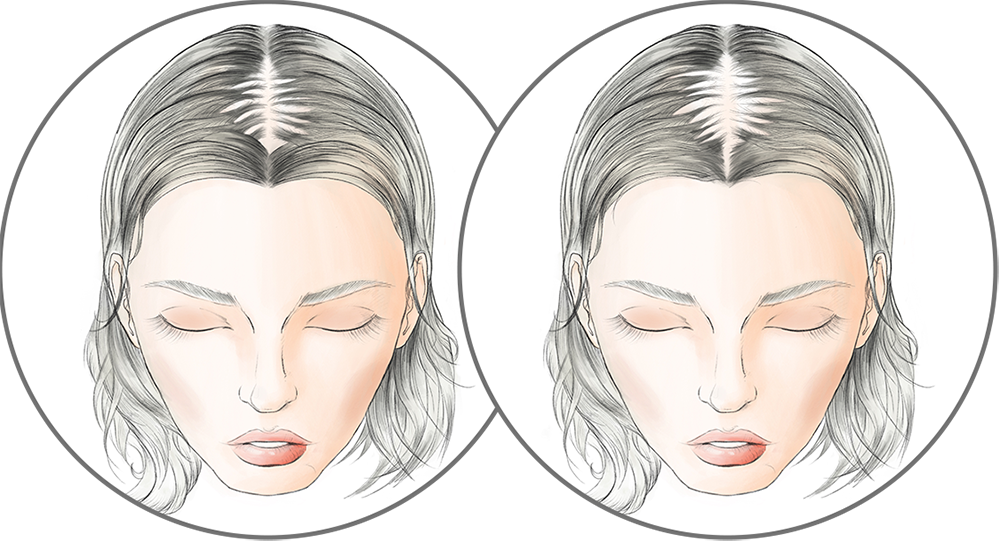 Beginning Stage hairloss diagram for Raquel Welch Transformations