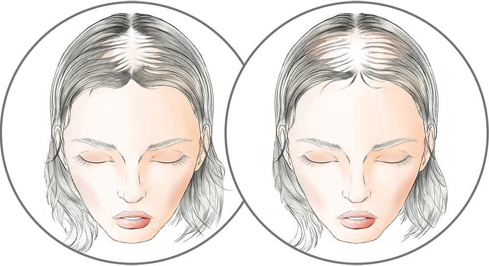 Moderate Stage hairloss diagram for Raquel Welch Transformations