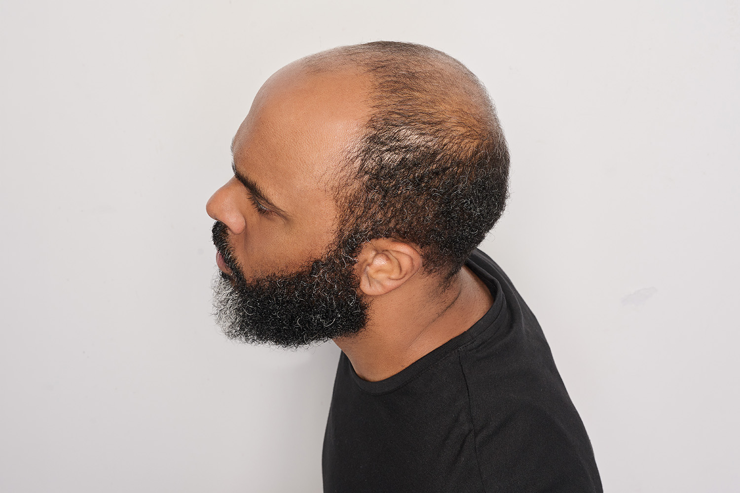 AHL - Khalan - Model - Before - B&A